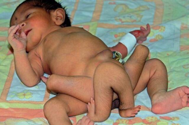 Pakistane sėkmingai operuotas su šešiomis kojomis gimęs kūdikis