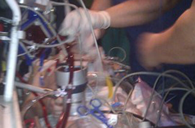 Pacientas pervežtas panaudojus „dirbtinius plaučius“