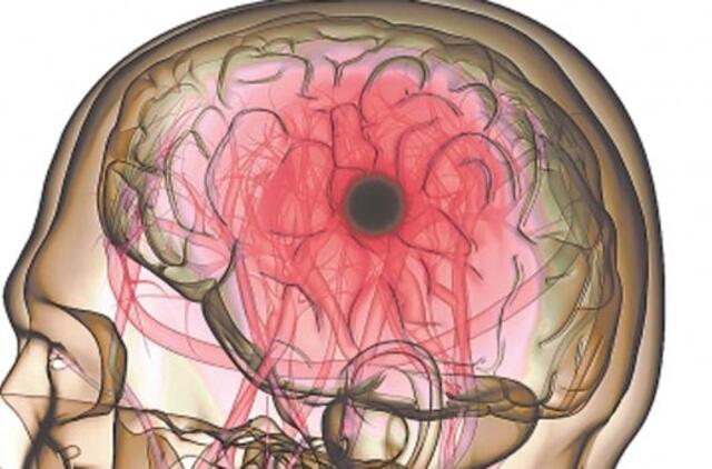 Kamieninių ląstelių tyrimas teikia vilties patyrusiems insultą