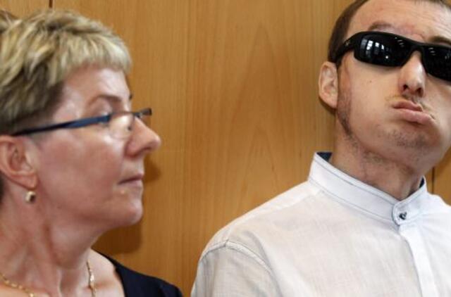 Lenkas po veido persodinimo operacijos išrašytas iš ligoninės