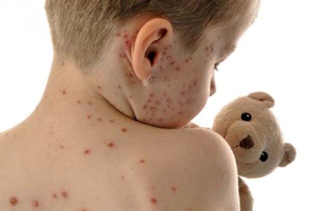 Ukraina kovoja su tymų protrūkiu