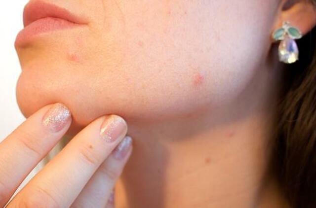 Odos problemos paauglystėje – dažniausios klaidos ir kaip jų išvengti?