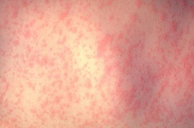 Raudonuke susirgti gali tiek vaikai, tiek suaugę: liga ypač pavojinga nėščiosioms