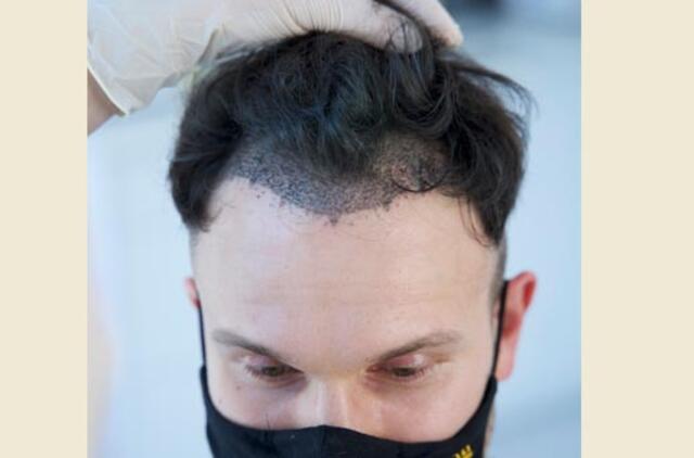 Plinkantis Vaidas Baumila ryžosi plaukų transplantacijai