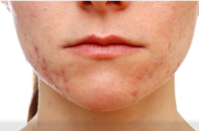 Gydantis spuogus, praverčia specialistų rekomendacijos ir savikontrolė