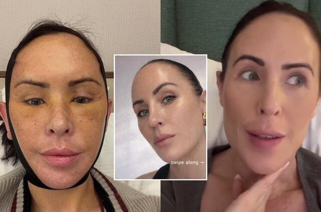 Moteris tikėjosi atjaunėti Turkijos chirurgų pagalba